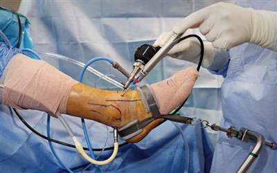 Ankles ARTHROSCOPY