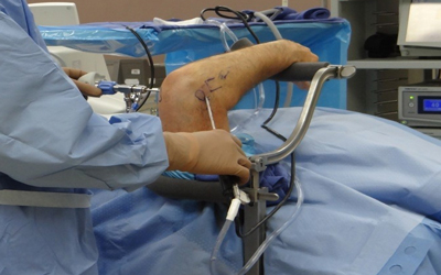 Elbows ARTHROSCOPY