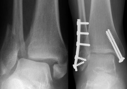 Ankle fracture and fixation