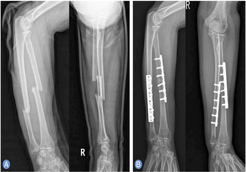 Hand fracture and fixation