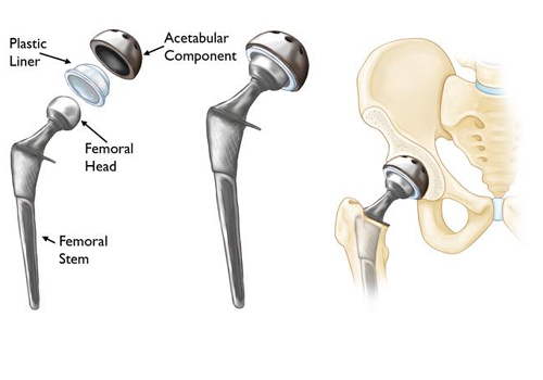 HIP JOINT REPLACEMENT