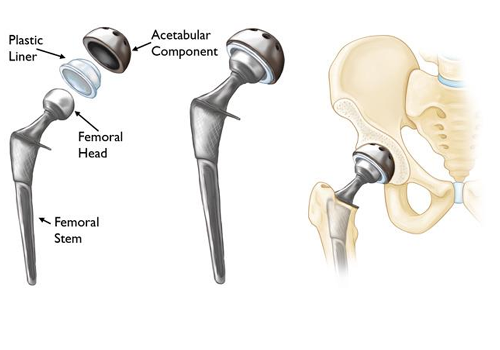 Hip Joint Replacement