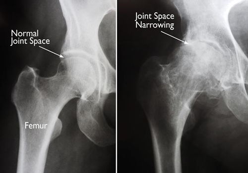 HIP JOINT REPLACEMENT