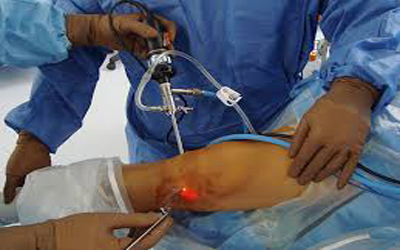 Knees ARTHROSCOPY