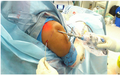 Shoulders ARTHROSCOPY