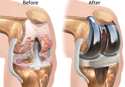 Total Knee Repalacement