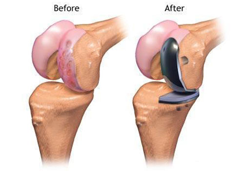 UNI KNEE REPLACEMENT