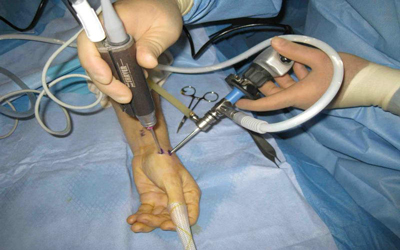 Wrists ARTHROSCOPY